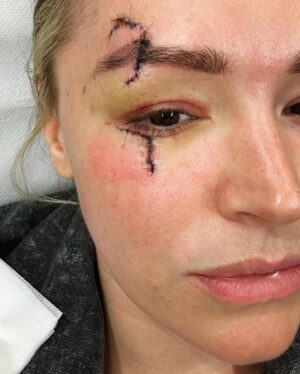Laura Woods Instagram - Just wanted to explain my absence from the telly for a little while, to be totally transparent and avoid any speculation. I had an accident last weekend at a holiday cottage. I swung a pillow and hit a large, glass lampshade hanging from the ceiling above me, which shattered and cut my face and arms, but luckily missed my eye. 

I wanted to say a couple of thank yous, firstly to Adam, for being my hero that day, acting so quickly and not leaving my side since and to his family for taking care of me in a time when I was petrified. To my agents Alex Maguire and Matthew Odonohue at CAA who searched for the best help immediately. To Dr Yannis Alexandrides and his wonderful medical assistant Zuzanna at 111 who opened their emergency surgery and came in on their days off, they were so gentle and have already worked magic that I didn’t think was possible to reduce the damage. 

I’ve added in the photos from then to now to show that even though it may look rough, it’s such a wonderful improvement already and I’m so grateful 🤍

It was a hell of a shock and I’ve been a bit sad, but I’m feeling very lucky it wasn’t worse. So a big thanks to my eyebrow too, for taking the brunt of it 😂 

I’m gutted I can’t cover the fight in Riyadh tomorrow anymore, but wishing the brilliant TNT boxing team all the best 🤍 

Be back soon xx