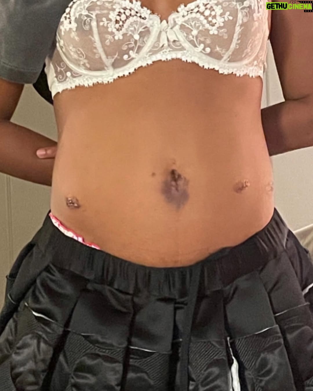 Taylour Paige - 45.5K Likes - ENDOMETRIOSIS AWARENESS MONTH! The lifelong journey of healing. Shows up in women who had to hold a lot in.Pain, heavy bleeding, adhesions- forcing oneself to take on & take in pain that doesn’t belong to you. I just saw this glorious thing on @theperiodlab she prompted “the body creates walls adhesions, just like the mind does. where are you blocking yourself from saying no and standing firm in your needs.” This has taken me a long time to learn. Goodness the self betrayal and abuse Ive internalized and would ruminate in. Those not for you benefit from this confusion. I’ve transmuted so much, but old habits die hard. A really violent illness that went undiagnosed for 20 years but caused me so much agony and turmoil. Finally had surgery fall of 2023 with Wonderful Dr Elizabeth Poynor thanks to my sister Lena. It was 4 hours long. It was on my colon, bladder and rectum. The pain would make me see stars. Throwing up every month. Sometimes couldn’t drive. the worst is how much you gaslight yourself. It’s almost like there’s no way you’re hurting this much? it definitely psychologically does something to you because it’s like you and no one around you believes the pain you’re in. The anxiety of next month. So many times I’ve ruined a costume or a good pair of jeans. In highschool my khaki uniform skirts. i learned over the last few years that endo is anger turned on yourself. You’re literally inflamed. That tracked for me. So many women are going THROUGH it okay. Be gentle with us. I am so grateful for what I’ve been able to turn around in myself over the last few years. I thank my body, I thank my husband, I thank my dear sister @ladylizzo who has taught me so much. My true health mentor. Thankful for acupuncture, clean water, protein, sauna, a calm nervous system because I’m experiencing healthy partnership and beautiful sisterhood. I’m thankful for good bloodwork and new days. Sunshine. good walks. Jumping on my mini trampoline. it’s not just one thing it’s a whole lot of things & I’m thankful we live in a time we can share & help each other! A few bloated pics, some post surgery, childhood internalizing, a good read. I love you #endometriosis