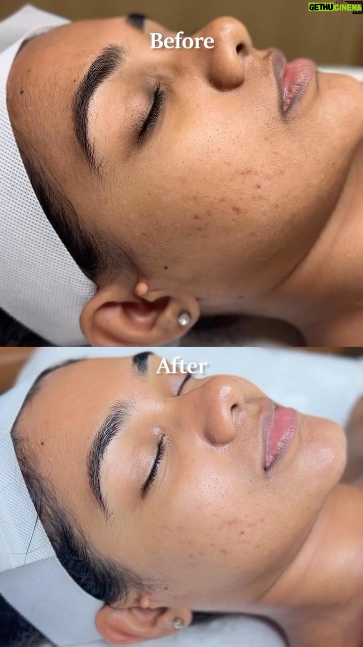 Vishnupriya - 5.9K Likes - Women’s day is around the corner and we bring to you Zazzle’s Exclusive Women’s Day Offer on ✨Hydra Facial✨
Get Zazzle’s Hydra Facial originally priced at INR 7500 just for INR 3999 this women’s day😍💃🏼✨
Details - Book your Hydra Facial session on March 8th 2023 (Women’s Day) at the exclusive offer price and redeem the service later✨💯
Please note - Offer valid only on March 8th 2023 on the occasion of Women’s Day‼️
Visit your nearest Zazzle ✨
☎️For appointments and other service details:
🌐 www.zazzlesalon.com
📍Trichy cantonment: 9610023456
📍Trichy Thillainagar: 8682077777
📍Coimbatore: 9610045678
📍Nungambakkam: 9610056789
📍Velachery: 7449015555
📍Thanjavur : 9944429295
📍Bangalore : 7353811111
📍Pondicherry: 9673722222
📍VR Mall Anna Nagar: 74187 77511
#ZazzleSalons #HydraFacial #Offer #WomensDaySale #WomensDay