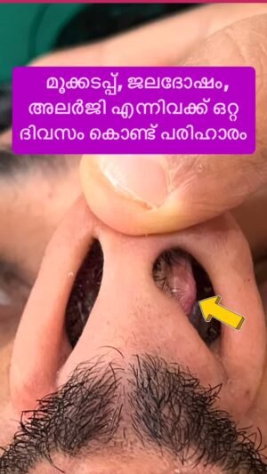 Jinsha Basheer Instagram - മൂക്കടപ്പ്, ജലദോഷം, അലർജി എന്നിവക്ക് ഒറ്റ ദിവസം കൊണ്ട് പരിഹാരം

#ent #rhinoplasty #snoring #allergy #doctor #doctortalk #entsurgery #entsurgeon #entdoctor #entdoctors #enthospital #plasticsurgery