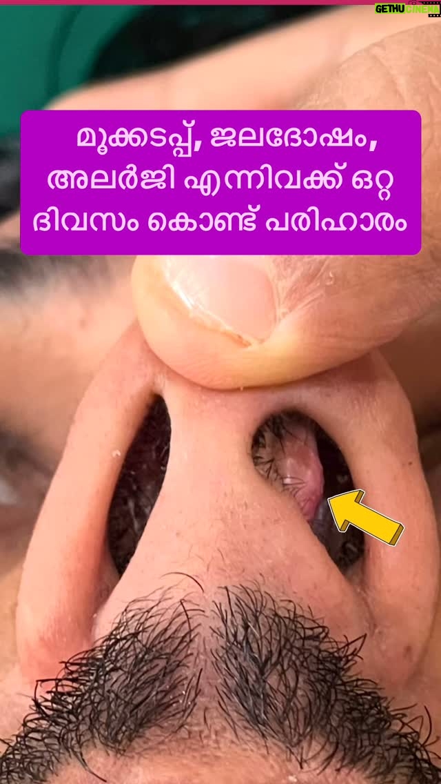 Jinsha Basheer - 3.3K Likes - മൂക്കടപ്പ്, ജലദോഷം, അലർജി എന്നിവക്ക് ഒറ്റ ദിവസം കൊണ്ട് പരിഹാരം
#ent #rhinoplasty #snoring #allergy #doctor #doctortalk #entsurgery #entsurgeon #entdoctor #entdoctors #enthospital #plasticsurgery