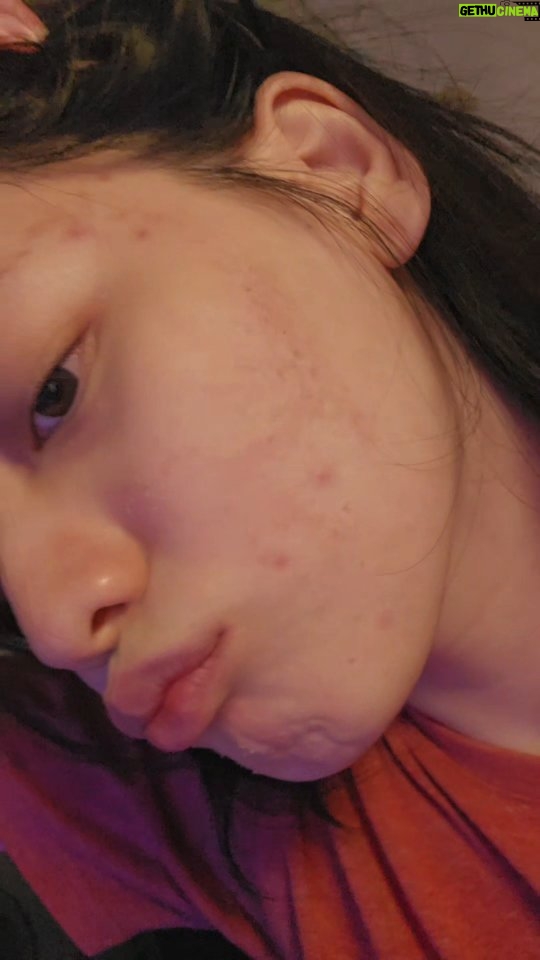 wynder waffe - 3.2K Likes - Day 3: PRP Facial Treatment ✨️