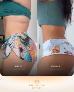 Andressa Soares Instagram - Antes e Depois: Andressa Soares (@mulhermelanciaoficial) 

Em março, a Andressa decidiu iniciar seu acompanhamento comigo, aqui no Instituto. Nesse período de cinco a seis meses, passamos juntas por dois protocolos e o resultado até aqui já impressiona: 11 quilos a menos. Houve pausas, ajustes e recomeços, mas cada etapa fez parte do processo e trouxe conquistas visíveis.

Agora, começamos um novo capítulo: o protocolo de definição, para valorizar ainda mais tudo o que já foi conquistado e seguir avançando.

✅ 11 kg eliminados
✅ Mais saúde e disposição
✅ Novo foco: definição

📩 Se você também quer viver esse processo de transformação, clique no link da bio e descubra como dar o primeiro passo no seu protocolo personalizado.