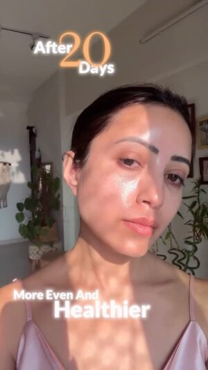 Debashree Biswas Instagram - Skin & More 🫶
Pigmentation can be super stubborn – whether it’s from acne scars, sun damage, or uneven skin tone. I struggled with it too… until I simplified my routine and focused on ingredients that actually work.

Here’s the 3-step routine that helped me:

1. Gentle Chemical Exfoliation (AHA/Glycolic Acid):
AHAs slough off dead skin cells and speed up cell turnover, helping fade pigmentation and reveal brighter skin underneath.

2. Dark Spot Correcting Serums:
Ingredients like Vitamin C, Alpha Arbutin, Niacinamide & Tranexamic Acid target melanin production and help lighten stubborn spots.

3. Daily Sunscreen – No Compromise:
Pigmentation will keep coming back if you’re not protecting your skin from UV rays. SPF is a must if you’re using actives like AHA or Vitamin C.

Consistency is everything – and trust me, the results are so worth it. Brighter, more even-toned skin with less visible pigmentation in just a few weeks!

{ hyperpigmentation, pigmentation, dark spots, skin & more}

#PigmentationTreatment #DarkSpotCorrector #SkincareRoutine #AHAExfoliation #NiacinamideSerum #GlycolicAcid #SkinBrightening #GlowingSkin #TextureFix #SkincareThatWorks #SkincareReel