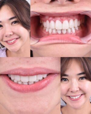 Gisella Anastasia Instagram - Siapa disini yang ngeh kalo gigi itu bisa jadi salah satu faktor yang ikut nentuin keindahan (estetika) penampilan wajah kitaaaa?
Perjalanan aku ngerapiin gigi sih lumayan yaaa dr jaman pindah Jkt waktu itu pasang behel, sampe udh rapiham trus kenal yg namanya veener..
Aku sih happy bgt bisa kenal dokter ian dari @smileart.id dan @flemingortho.id ..
Sm dr Ian, veneerku tu disempurnakan lg💕
Pas banget kmrn itu usia veneer pertamaku udah 8 tahun, jd udh waktunya diganti..
Dan aku SUKAAA BANGET sm hasilnyaaa..
Aku jadi lebih pede sehari2 dan makin seneng senyum😜
Makasi ya dok buat ke’perfeksionis’annya yang akhirnya bikin hasil veener nyaa cakep bgt! 🤸♀️
Makasi jg buat perjalan bongkar veener, cetak gigi sementara, sampe pemasangan gigi barunya yg painless, rapih, dan menyenangkan.
Untuk skrg sih ak ganti yang atas dulu ya dokk nabung2 dulu dan cari waktunya🤪 nanti next time kita gas yg gigi bawahnya lg..
Sukses selalu!!💕