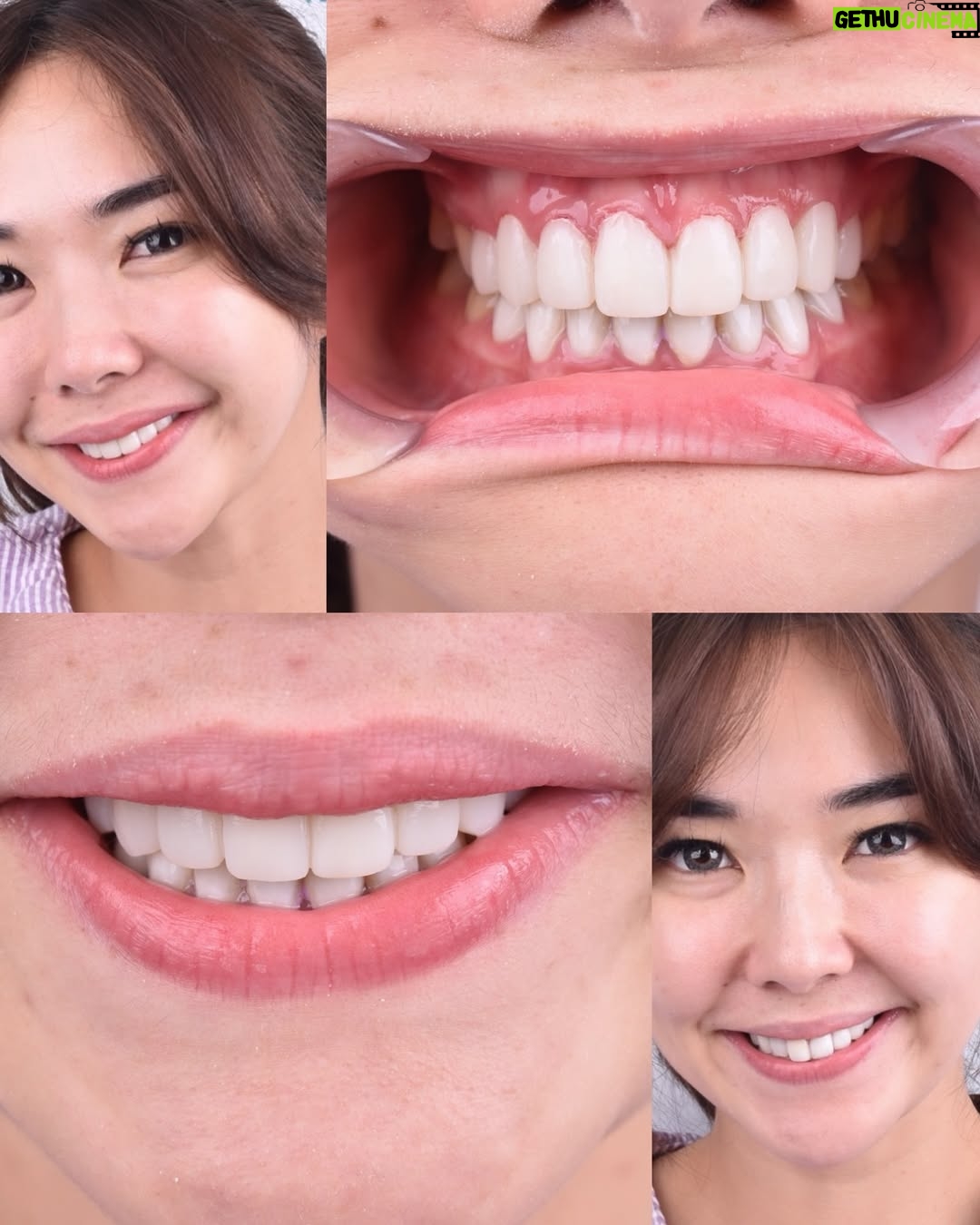 Gisella Anastasia - 50.9K Likes - Siapa disini yang ngeh kalo gigi itu bisa jadi salah satu faktor yang ikut nentuin keindahan (estetika) penampilan wajah kitaaaa? 

Perjalanan aku ngerapiin gigi sih lumayan yaaa dr jaman pindah Jkt waktu itu pasang behel, sampe udh rapiham trus kenal yg namanya veener..

Aku sih happy bgt bisa kenal dokter ian dari @smileart.id dan @flemingortho.id ..
Sm dr Ian, veneerku tu disempurnakan lg💕
Pas banget kmrn itu usia veneer pertamaku udah 8 tahun, jd udh waktunya diganti..

Dan aku SUKAAA BANGET sm hasilnyaaa..
Aku jadi lebih pede sehari2 dan makin seneng senyum😜

Makasi ya dok buat ke’perfeksionis’annya yang akhirnya bikin hasil veener nyaa cakep bgt! 🤸‍♀️
Makasi jg buat perjalan bongkar veener, cetak gigi sementara, sampe pemasangan gigi barunya yg painless, rapih, dan menyenangkan.

Untuk skrg sih ak ganti yang atas dulu ya dokk nabung2 dulu dan cari waktunya🤪 nanti next time kita gas yg gigi bawahnya lg..

Sukses selalu!!💕