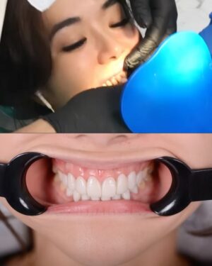 Gisella Anastasia Instagram - Siapa disini yang ngeh kalo gigi itu bisa jadi salah satu faktor yang ikut nentuin keindahan (estetika) penampilan wajah kitaaaa?
Perjalanan aku ngerapiin gigi sih lumayan yaaa dr jaman pindah Jkt waktu itu pasang behel, sampe udh rapiham trus kenal yg namanya veener..
Aku sih happy bgt bisa kenal dokter ian dari @smileart.id dan @flemingortho.id ..
Sm dr Ian, veneerku tu disempurnakan lg💕
Pas banget kmrn itu usia veneer pertamaku udah 8 tahun, jd udh waktunya diganti..
Dan aku SUKAAA BANGET sm hasilnyaaa..
Aku jadi lebih pede sehari2 dan makin seneng senyum😜
Makasi ya dok buat ke’perfeksionis’annya yang akhirnya bikin hasil veener nyaa cakep bgt! 🤸♀️
Makasi jg buat perjalan bongkar veener, cetak gigi sementara, sampe pemasangan gigi barunya yg painless, rapih, dan menyenangkan.
Untuk skrg sih ak ganti yang atas dulu ya dokk nabung2 dulu dan cari waktunya🤪 nanti next time kita gas yg gigi bawahnya lg..
Sukses selalu!!💕