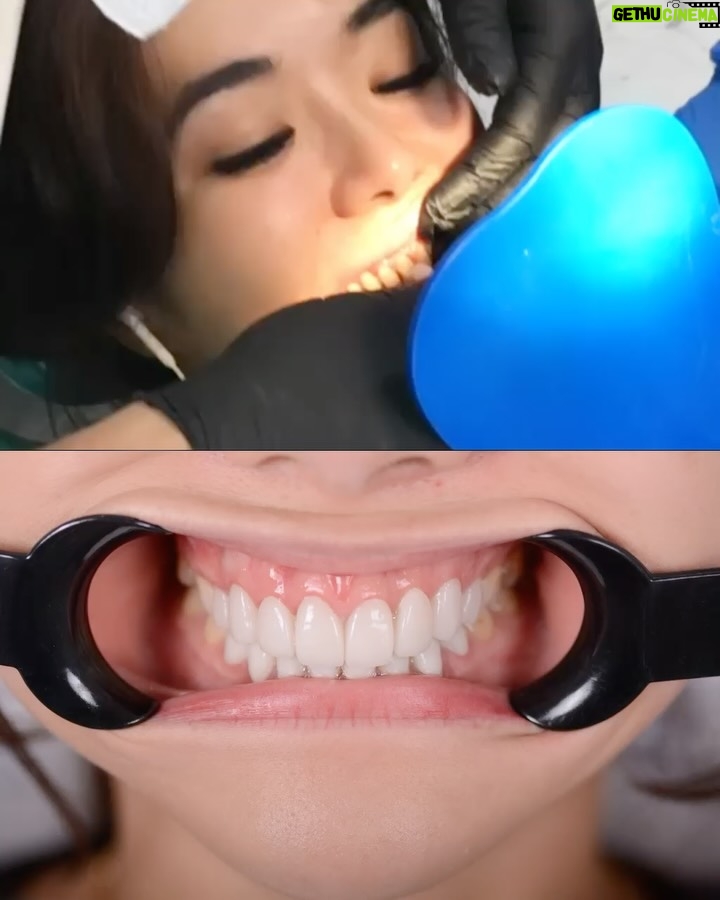 Gisella Anastasia - 50.9K Likes - Siapa disini yang ngeh kalo gigi itu bisa jadi salah satu faktor yang ikut nentuin keindahan (estetika) penampilan wajah kitaaaa? 

Perjalanan aku ngerapiin gigi sih lumayan yaaa dr jaman pindah Jkt waktu itu pasang behel, sampe udh rapiham trus kenal yg namanya veener..

Aku sih happy bgt bisa kenal dokter ian dari @smileart.id dan @flemingortho.id ..
Sm dr Ian, veneerku tu disempurnakan lg💕
Pas banget kmrn itu usia veneer pertamaku udah 8 tahun, jd udh waktunya diganti..

Dan aku SUKAAA BANGET sm hasilnyaaa..
Aku jadi lebih pede sehari2 dan makin seneng senyum😜

Makasi ya dok buat ke’perfeksionis’annya yang akhirnya bikin hasil veener nyaa cakep bgt! 🤸‍♀️
Makasi jg buat perjalan bongkar veener, cetak gigi sementara, sampe pemasangan gigi barunya yg painless, rapih, dan menyenangkan.

Untuk skrg sih ak ganti yang atas dulu ya dokk nabung2 dulu dan cari waktunya🤪 nanti next time kita gas yg gigi bawahnya lg..

Sukses selalu!!💕