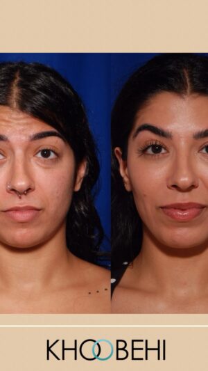 Jasmine Sherni Instagram - Dr. Khoobehi explains how facial balancing with filler and Botox enhances your natural features — not changes them. The goal? A refreshed, harmonious look that’s still 100% you. 💉✨