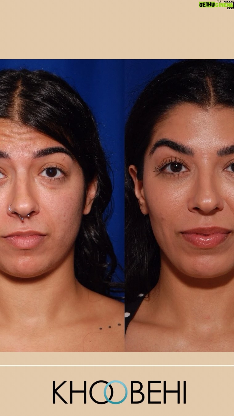 Jasmine Sherni - 6.3K Likes - Dr. Khoobehi explains how facial balancing with filler and Botox enhances your natural features — not changes them. The goal? A refreshed, harmonious look that’s still 100% you. 💉✨
