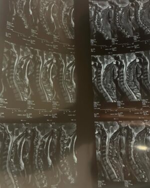 Milett Figueroa Instagram - Gracias a la gente que nos estuvo apoyando durante toda la competencia, jamás imagine que una lesión en la cervical me podía dejar fuera, pero así es esto, las ganas y la pasión no se van❤️🔥 GRACIAS @gabriel._.renteria eres un gran compañero y un bailarín de primera, una estrella y seguirás brillando en cualquier escenario, @magudelrio y @facuarrigoni gracias por todo son increíbles❤️🔥 🙏🏼✨ Gracias infinitas @marcelotinelli @elchatoprada y @hoppefede @lafliaok @eugelopezfrugoni @mlolorossi por esta increíble oportunidad por el cuidado y el amor🙏🏼💘gracias a toda la producción, me encantó conocerlos,no me imaginé que tomar un vuelo para Argentina me haría conocer gente tan increíble, me encantó conocer a los jurados y a cada uno de mis compañeros, se todo el esfuerzo que exige esta competencia y no es fácil, así que denlo todo❤️🔥!! Gracias @vilarinomery y a todo el equipo de vestuario y maquillaje, @rodrigomesina @verofioravanti @tefi.giraldo @soficosta.makeup @son todas unas genias!!💘me encantó conocerlos, aprendí y disfruté demasiado, me hubiera encantado seguir dándolo todo, para ver hasta donde podíamos llegar! nunca se deja de disfrutar la pista y espero poder volver. Gracias @doctor_furman seguiré con mi recuperación para poder volver a bailar ❤️💃🏻