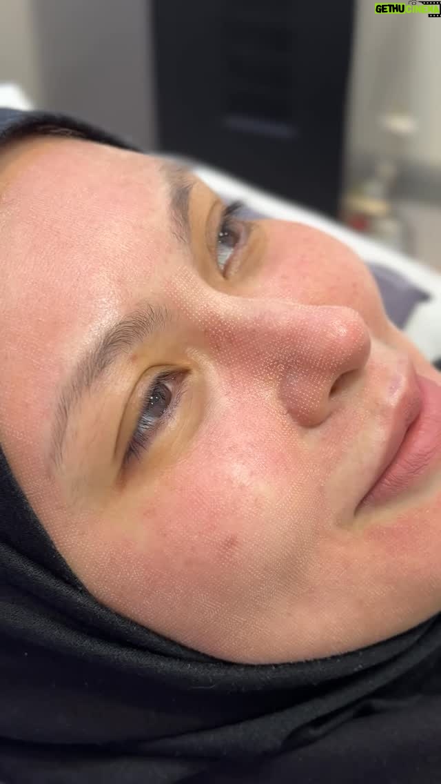 Mona Allen - 55 Likes - Hari muka dibakar di @vogueclinickl 🔥🔥🔥🙀

Say hello to a fresh start for your skin with Vogue Fractional CO2 Laser — the gold standard in skin resurfacing and rejuvenation.

Whether you’re dealing with acne scars, fine lines, uneven skin texture, or sun damage, this powerful yet precise laser treatment stimulates collagen production from deep within, revealing smoother, brighter, and younger-looking skin over time.

Downtime? Yes, but it’s worth it. Results? Transformative. Confidence? Restored.

One session can make a visible difference, but a customized plan delivers long-term glow.

Why Vogue Fractional CO2 Laser?
	•	FDA-cleared & dermatologist-recommended
	•	Targets deep skin layers for maximum collagen boost
	•	Reduces scars, pigmentation, and signs of aging
	•	Improves overall skin texture & tightness

Glowing skin isn’t a trend — it’s a lifestyle. Book your consultation today and start your journey to clearer, healthier skin.

#VogueCO2 #FractionalCO2Laser #SkinRejuvenation #LaserResurfacing #AcneScarTreatment #AntiAging #FlawlessSkin #SkincareGoals