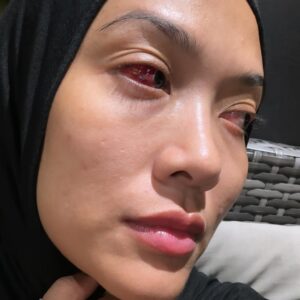 Syatilla Melvin Instagram - Bukan angkara zarif…..
:
Tilla sakit mata plus muntah2, cerry berry dah seminggu. Akibat pressure muntah, mata jadi mcm ni👆🏻😭 sapa pernah?
:
Kepada yg mencari tilla, mintak maaf mmg tilla xbukak reply wasap apa pun sebb tilla lembik xdak energy. Anak2 pun sama. Harini baru boleh senyum sikit🥹
