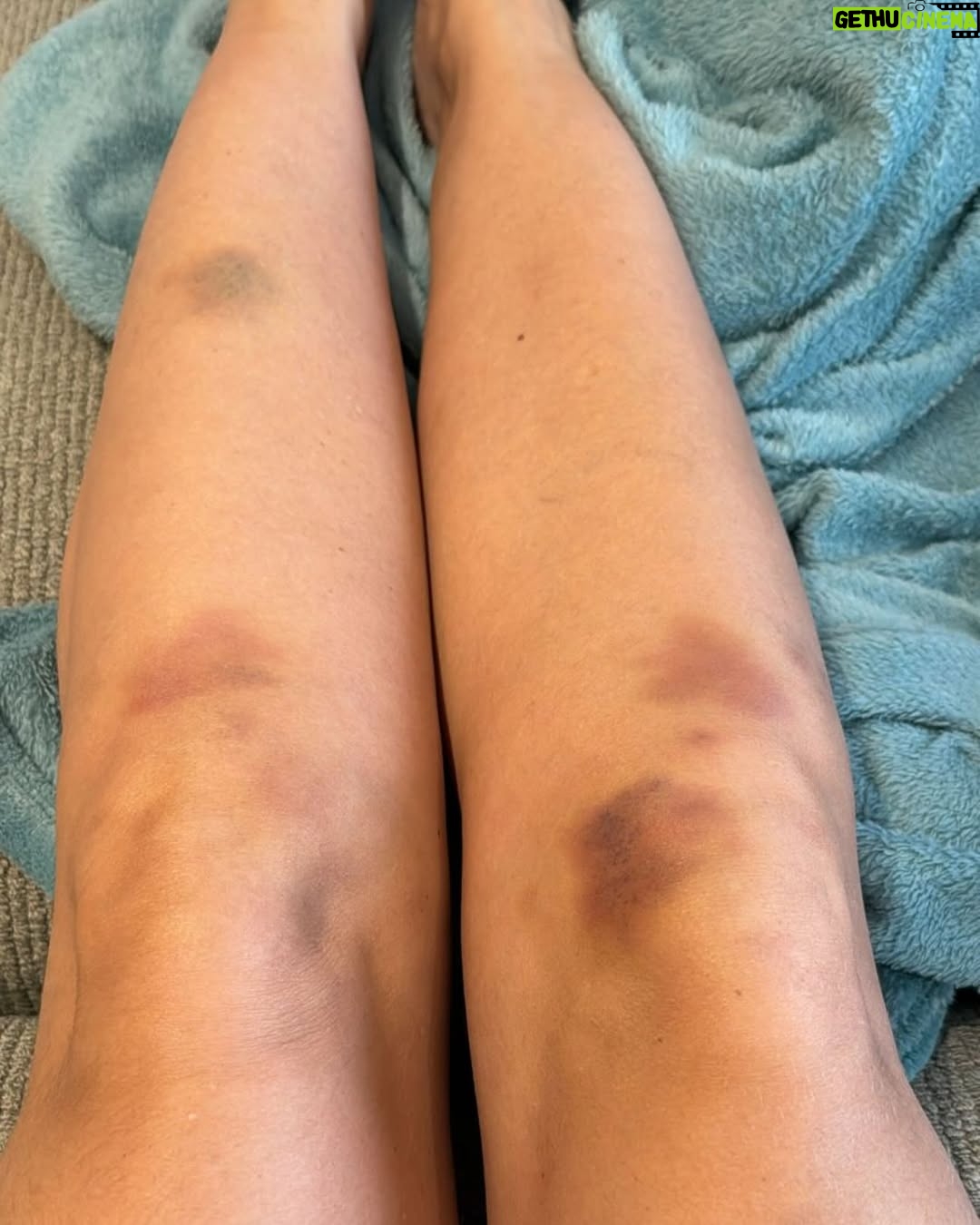 Yasmin Brunet - 314.6K Likes - Parece que o corpo da mulher nunca sai de cena, sempre alvo de julgamentos. Se engorda, é criticado. Se emagrece, também. Estamos sempre ‘demais’ ou ‘de menos’. Falam do corpo como se ele não mudasse com o tempo - recebi comentários horrorosos sobre isso. Recentemente, enfrentei o lipedema, um problema de saúde que impactava, acima de tudo, a minha qualidade de vida. 

Com o tratamento, adquiri novos hábitos e perdi peso, mas, em vez de enxergarem saúde, surgiram críticas sobre estar “magra demais”, com fofocas sobre bichectomia, harmonização fácil, procedimentos estéticos e até comentários de que meu rosto estaria “fino demais”. Disseram que eu estou com ‘rosto de caveria’. É sério isso?

Esse ciclo de cobranças e suposições levanta uma questão importante: quem definiu os padrões que dizem o que é “aceitável” ou “belo”? Quem define o que é ‘adequado’ ou ‘ideal’? O corpo feminino, assim como cada fase da nossa vida, carrega histórias, mudanças e, sim, o passar do tempo. Mas, enquanto muitos apontam o dedo, esquecem que a verdadeira liberdade está em respeitar o nosso próprio ritmo e os nossos processos. 

Falam do corpo como se não refletisse nossas histórias, mudanças, dores. Quando lidamos com um problema de saúde, como foi meu caso, e buscamos tratamento, as críticas são outras. Mudam o foco, não os julgamentos. 

Que tal, ao invés de “como o corpo deveria ser”, a gente falar sobre o que realmente importa: nossa saúde, felicidade e o respeito aos nossos próprios tempos e processos? E se, ao invés de julgar, a gente começasse a acolher? Não há um único padrão para a beleza ou para a saúde – cada mulher tem seu próprio tempo, sua beleza, e uma jornada única. 

Que possamos celebrar a individualidade e entender que o verdadeiro autocuidado e a verdadeira aceitação começam dentro de cada uma de nós. Isso, sim, merece ser celebrado.