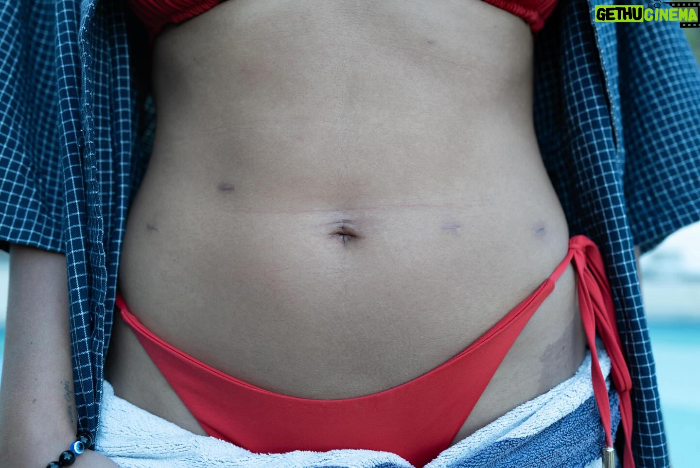 Aisha Dee - 57.2K Likes - To my sweet darling Endometriosis, you are one conniving little bitch. We’ve experienced so much together! A whole decade of chronic pain, medical gaslighting, nausea, cramps that felt like barbed wire and fire shooting throughout my entire body, the resulting feelings of isolation and paranoia… hectic stuff. And though I have loved this “lesson” in patience and endurance, I am so so grateful to see the ass-end of you. I promise to use my privilege to spread awareness and act as a resource and support for my fellow endo babies. I promise to never take my body for granted. I promise to go outside and throw my ass around in a circle this summer. Thank you body! Thank you thank you thank you, amen xo