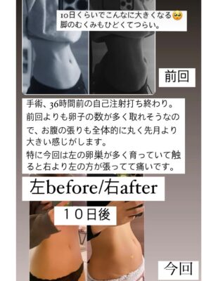 Ayame Misaki Instagram - 【できても、できなくても】

10月から始まるドラマがニュースで取り上げられ、
有難いことに多くの方から反響をいただきました。
その中で誤解を避けるために、この場を借りて“私個人の意見”をお伝えできればと思います。

人生の選択肢は一つではない。
子どもを持つことで得られる幸せもあれば、大変さもある。パートナーと二人きりの生活には淋しさもあるけれど、旅行や時間を共有する喜びもある。一人で生きる選択だって当然あり。

今の時代は妊娠や結婚に限らず、多様な選択肢が認められる時代です。そうした意味でも、私は昔から「できても、できなくても」という考えを大切にしてきました。

卵子凍結を決意した背景をお話すると
数年前、まだ「卵子凍結」という言葉も国の制度（助成金など）も整っていなかった頃に、私は卵子凍結をしました。
当時、私のAMH値は年齢の平均より低く、20代半ばから関心を持ち調べ続け、30歳でようやく決意しました。

卵子凍結には2種類あって、未受精卵と受精卵。
不妊治療で採卵した卵は未受精卵から受精卵にする時にも一部しか受精しません。
そして、胚盤胞になるのも受精卵の一部である事。そこから着床するのかどうか……。
このくらい奇跡の連続というわけです。

卵子凍結は手術だけではなく、妊娠、出産、そして出産してからも大変な事だらけで、卵子凍結がゴールなわけではありません。

多くの女性は月に一度の生理があれば
いつでも「妊娠できる」と考えがちですが、必ずしもそうではありません。

例えば…
若いうちはまだ良いですが、産まれた瞬間から生理のたびにどんどん減っていくので個数が決まっている事。

年齢を重ねれば重ねるほど排卵(受精卵になれる子たち)が困難になっていくこと。
生理12回のうち妊娠可能な卵が排卵されるのは半分程度になるかもしれない。

私自身、病院に行くまでは知らなかったことばかりでした。
きっと多くの女性も、そして男性はなおさら知らない現実だと思います。
妊娠出来る期間も、回数も制限されてきて、気がついた時には遅かったと後悔してしまうかもしれない。

卵子凍結(未受精卵でも受精卵でも)をしたからといって確定で妊娠、出産出来るわけではない。
あくまで病気になった時や、不妊治療の藁にもすがるわずかな望みです。
そうなった時に、少しでもその時の自分への心の支えになればいいなぁと。私ができても、できなくても、そして【保険】という言葉を使ったのは、そういう理由でした。

私は国の制度を使っていないので、今どれだけの助成金などが出てるのかこの場では分からないですが…正直費用はめちゃくちゃ高い。手術も高いですが、毎年の管理費用も高い。

そして、身体への負担も軽くはありません。
ホルモン自己注射、薬の服用、採卵手術をするにあたり、下腹部の張り、浮腫み、眠気、吐き気などの副作用もあります。
私は1回での採卵では足りず4回に分けて採卵しました。ホルモンバランスも崩れその度に悪くなる体調もあったりと、ドラマ撮影の合間に病院へ通う日々を過ごしました。

なので、時代的に少子化だから卵子凍結しましょう！と推薦してるわけでもなく、若いうちに産んでおいた方がいい！(もちろん、若いと体力的には安心だけど)というわけでもなく、それぞれの人生があると思うので、産む産まないに限らず、人生には人の数だけ選択肢があるので、どれが正しい・間違っているというものではないからです。理解して、そしてお互いに尊重していけたら素敵だなと思います。

卵子凍結は、あくまで将来のための
わずかな投資とわずかな希望だと私は思っていて、言葉だけが先行して「流行」のように受け取られるのも違うと思います。
ただ、自分の心に正直に、納得できる道を選んでほしい。人生は選択の連続です。
皆さんそれぞれの選択が、素敵な輝かしい人生につながりますように。

#卵子凍結