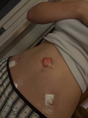 Lily Brooks O'Briant Instagram - Endometriosis is a disease that affects 1 in 10 women. I am 1 in 10. This past week I had my second endometriosis surgery. My first was two years ago at age 17 where @seckinmd removed 21 lesions. I am incredibly grateful to have been treated by 3 of the very best Endometriois excision surgeons in the world (seriously ask Google) @camrannezhatmd @seckinmd and @drchu_endodoc . The trip to nyc was pretty tough on me last surgery so I had my surgery in CA with Dr Nezhat who removed 24 lesions from my ovaries, fallopian tubes, intestines, nerves in my back, bladder & more. I was doing everything I could to manage my endo symptom - anti-inflammatory diet, supplements, acupuncture, lymphatic drainage massages, managing stress & more but needed this second surgery. I am so grateful to be healing now #endowarrior 
#endometriosis @endofound 💜💛

my mom got some very silly videos of me after being under anesthesia