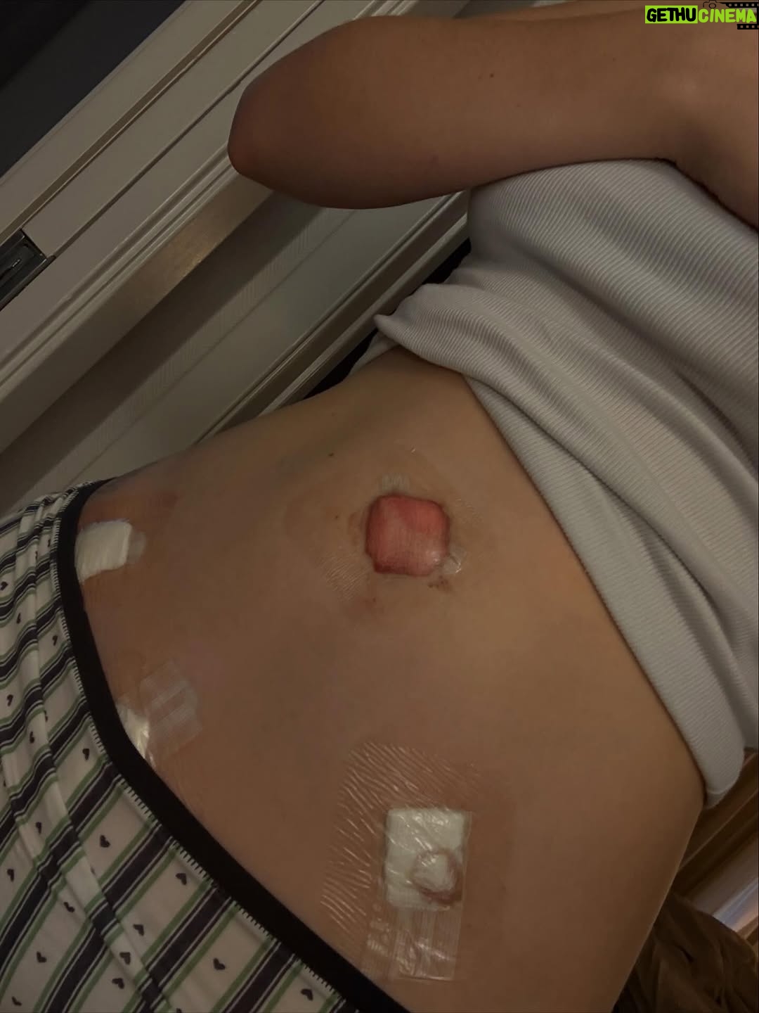 Lily Brooks O'Briant - 7.1K Likes - Endometriosis is a disease that affects 1 in 10 women. I am 1 in 10. This past week I had my second endometriosis surgery. My first was two years ago at age 17 where @seckinmd removed 21 lesions. I am incredibly grateful to have been treated by 3 of the very best Endometriois excision surgeons in the world (seriously ask Google) @camrannezhatmd @seckinmd and @drchu_endodoc . The trip to nyc was pretty tough on me last surgery so I had my surgery in CA with Dr Nezhat who removed 24 lesions from my ovaries, fallopian tubes, intestines, nerves in my back, bladder & more. I was doing everything I could to manage my endo symptom - anti-inflammatory diet, supplements, acupuncture, lymphatic drainage massages, managing stress & more but needed this second surgery. I am so grateful to be healing now #endowarrior 
#endometriosis @endofound 💜💛

my mom got some very silly videos of me after being under anesthesia