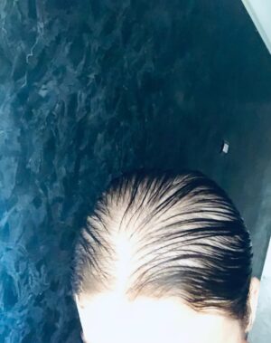 Rahma Hassan Instagram - This is my hair this is what I’m dealing with everyday.. two years now… my health is okay elhamdollh, but my heart is broken I have stress all the time.. I even don’t want to do anything because of this….. you have no idea how tired I am…I never show… so I want to share. I’m not going to delete it now. Until I’m really okay.
شعري ابتدا يقع من الجذور و يقع اكتر بعد ما رحت عيادة زو Zo في الزمالك و المفروض انه افضل حاجة موجودة .. كشفت و عملت التحليل المطلوبة كلها .كان شعري عادي خفيف تعبان لكن مش بيقع بيقع كام شعرة عادي ! بعد ما روحت و عملت التحليل الدكتورة قالتلي كلها تمام ممكن بس الحديد نازل شويا ! ممكن ناخد حديد … و هنعمل بلازم من دمك يعني حاجة كويسة و امان ميه في المية! اوكي . طبعا .. المهم روحت و سالتني الدكتورة قبل البلازمة بعد سحب الدم ! اخبار الظغط بتاعك ايه ! قولت مش عارفة ! قالتلي طيب المهم عملت اللازمة و و ميزوثاربي!!!! مش بلازمة بس ! الكارثة انه حططلي حقنة مينوكسيديل مع الحقنة و عملتها بالميزوثاربي! و طبعا انا معرفتش غير لما روحت البيت لان كان ضربات قلبي غريبة و حسا اني تعبانة و دماغي ثقيلة … بشوف الفاتورة لقيته انها حططلي مينوكسيديل بدون ما ترجعلي الاول و انا كنت بس مفروض اعمل بلازمة فقط من دمي … بس .من ساعتها شعري بيقع كل يوم و مافيش بيبي هير بيطلع اصلا و لو طلع بيقع تاني علي طول …. لو اعرف من الاول مكنتش روحت ابدا ..لانهم حطولي حاجة اول مرة استعملها بدون مايرجعولي الاول .. و في حاجة مهمة زي دي كان عندي ثقة قبل ما اروح لكن طبعا بعد اللي حصل مروحتش تاني ابدا و شعري فضل يقع من ساعتها … اكتر و اكتر و كل الناس عارفة انك لو استعملت المينوكسيديل مينفعش يتوقف … و هما عملو الكارثة دي بدون ما يقولولي الاول حتي … و من ساعتها و انا شعري و نفسيتي في الارض .