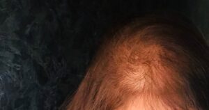 Rahma Hassan Instagram - ⁨	لاسف حالت شعري اوحش بكتير يوم عن يوم بسبب اللي العيادة استخدمته علي شعري … كل يوم بكتشف انهم ارتكبوا في حقي جريمة و ممكن تكون عاهة مدي الحياة … فا للبنات اللي بتبعت لي عوزة علشان تعرف عالجت شعري ازاي ..شعري لسه زي ما هو .. اخدت فيتامينات حطيت محاليل علي شعري عملت تحليل كتير الفترة اللي فاتت لكل حاجة و الحمدلله مافيش حاجة داخلية..كل حاجة كانت بسبب العيادة و الدكتورة و اللي و استخدمتة علي شعري طريقة العلاج اللي  مش مناسبة ابدا ليه شعري الاساسي الثقيل كلة وقع نوع الشعر اختلاف بسبب الكارثة اللي عملتها الدكتورة و العيادة اللي مسؤولة … فا لكل اللي بيطمن عليا فا حالتي شعري اسواء بكتير ..⁩

عارفة اني بكتب غلط ! مخي بيكتب كدة من غير تعديل .. عارفة الحروف الصح ايدي و مخي بيكتب كده 🤍