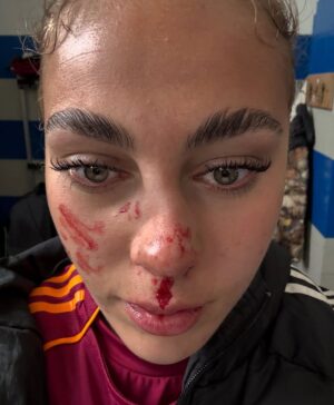 Alayah Pilgrim Instagram - left the pitch with a win… but my nose didn’t make it 🫠🥹