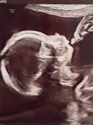 Jess Impiazzi Instagram - It’s been hard keeping this secret, especially as a huge over sharer 😂🩵
It’s not been an easy journey but my @sambird_official has been there through every ivf appt, every jab, every hospital appt, and I love him so much. We’re so excited to welcome our little boy in May 2026 and cannot wait to meet him 🩵🩵

You can read about our journey and my fertility issues in this weeks @closeronline (magazine) and how lupus and fertility has been quite the challenge 🩵 #lupusfertility #lupus #ivf