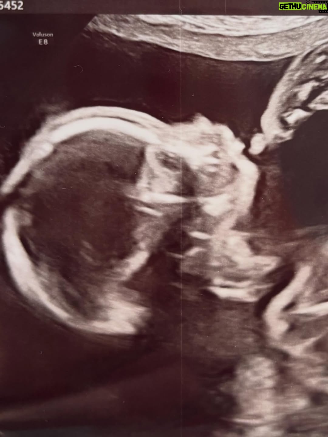 Jess Impiazzi - 18.8K Likes - It’s been hard keeping this secret, especially as a huge over sharer 😂🩵
It’s not been an easy journey but my @sambird_official has been there through every ivf appt, every jab, every hospital appt, and I love him so much. We’re so excited to welcome our little boy in May 2026 and cannot wait to meet him 🩵🩵

You can read about our journey and my fertility issues in this weeks @closeronline (magazine) and how lupus and fertility has been quite the challenge 🩵 #lupusfertility #lupus #ivf