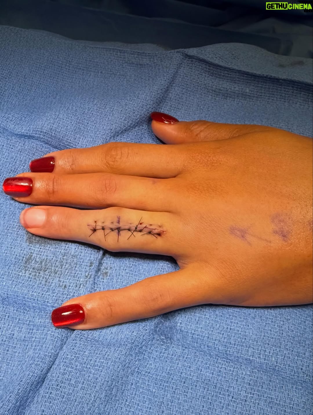 Bianca Crawford - 140.6K Likes - 10 months post injury, 8 months of rehab, 5 Dr’s Later…
And we are FINALLY here.
Now I can finally start to put this behind me.
Thank you so much @dr.karandesai for hearing me and fixing me!

Fingers and JOINTS are complicated, frustrating, confusing, essential… if you don’t get it… consider yourself lucky and I hope you never have to find out. 
Maybe one day I’ll go into detail but it’s a lot.

Thank you to those who have sent so much love my way and continue to.
💋

*Graphic photo from surgery… I was going to post the video but it was a little more graphic than the photo and I didn’t want to freak out some people too badly lol*