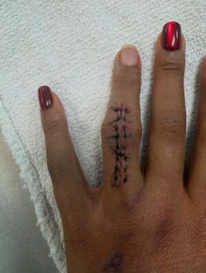 Bianca Crawford Instagram - 10 months post injury, 8 months of rehab, 5 Dr’s Later…
And we are FINALLY here.
Now I can finally start to put this behind me.
Thank you so much @dr.karandesai for hearing me and fixing me!

Fingers and JOINTS are complicated, frustrating, confusing, essential… if you don’t get it… consider yourself lucky and I hope you never have to find out. 
Maybe one day I’ll go into detail but it’s a lot.

Thank you to those who have sent so much love my way and continue to.
💋

*Graphic photo from surgery… I was going to post the video but it was a little more graphic than the photo and I didn’t want to freak out some people too badly lol*