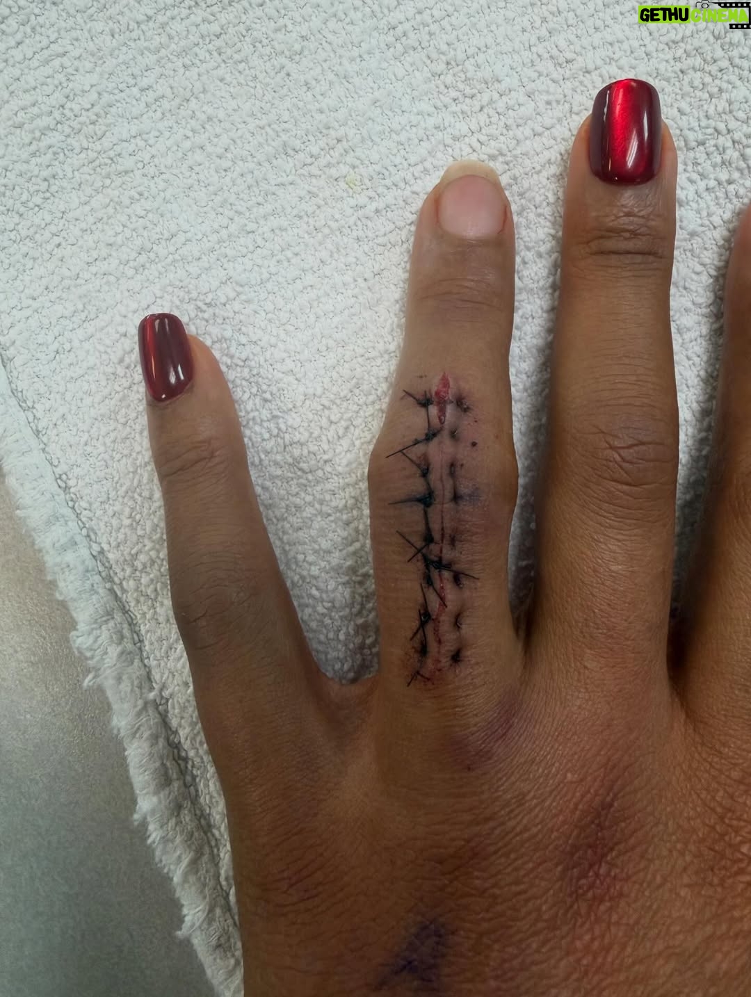 Bianca Crawford - 140.6K Likes - 10 months post injury, 8 months of rehab, 5 Dr’s Later…
And we are FINALLY here.
Now I can finally start to put this behind me.
Thank you so much @dr.karandesai for hearing me and fixing me!

Fingers and JOINTS are complicated, frustrating, confusing, essential… if you don’t get it… consider yourself lucky and I hope you never have to find out. 
Maybe one day I’ll go into detail but it’s a lot.

Thank you to those who have sent so much love my way and continue to.
💋

*Graphic photo from surgery… I was going to post the video but it was a little more graphic than the photo and I didn’t want to freak out some people too badly lol*