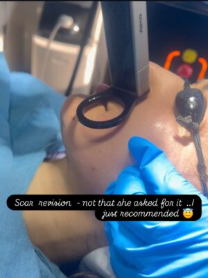 Charlie Chauhan Instagram - Some moments in medicine come full circle… and stay with you forever😇
Nearly 25 years ago, as a young medical officer, I performed an emergency surgery on a little girl— who had suffered a severe through-and-through lip-to-cheek injury after an accident. It was one of those cases where you just act on instinct, skill, and faith… hoping life will be kind to the child beyond the operation theatre.
Today, she walked into my clinic again.
Not as a patient defined by a scar… but as a confident young woman seeking a natural revision. She didn’t even know she was meeting the same doctor who had stitched her face and her future together decades ago.
The scar did not stop her dreams.
It did not define her story.
She grew up to become an accomplished actor — the radiant #charlie Chauhan.
Moments like these give you goosebumps. They remind you why you chose medicine… why you stayed… and why #gratitude quietly becomes the strongest emotion you carry.
Life has its own way of returning blessings — unexpectedly, beautifully, and again and again.
So much to be thankful for😇🙏✨🌷