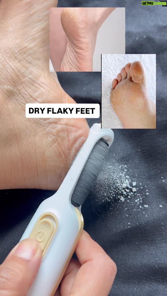 Kiwi Tandon - 7.4K Likes - One of my best purchases of 2025 💯details….
#nonsponsored 
Winter makes dry feet and cracked heels such a common problem, and this little tool is honestly a mini pedicure at home.❕

I use it twice a month not more because it’s basically exfoliating your feet, and you don’t want to over-scrub.
But the results? Instant smooth feet! ✨ 

Just make sure to apply a good moisturizer afterwards, and everyday  anyways :) and you’re sorted. 💅🧴

It’s from Winston ( NOT sponsored) 

( dry feet, calus feed, cracked heel, crack feet, foot care ,Winston calus remover , crack heels, feet cream , beauty tools, winter feet)
#wintermusthaves #dryfeet #roughfeet #crackedheels #crackedfeet #dryheels #crackedheel #beautytools #dryfoot #footcare #feetcare #feetproblems