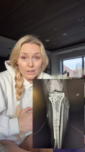 Lindsey Vonn Instagram - I’m finally out of the hospital!!! 🙌🏻 After almost 2 weeks of laying in a hospital bed almost completely immobile, I’m finally well enough to move to a hotel. It’s not home yet, but it’s a huge step!

I hope I explained my injury well enough. I’m not a doctor so if I don’t explain something perfectly please forgive me. When the injury happened the situation was quite challenging in many ways but in the end, the situation was brought back into control. Again, thank you Dr Tom Hackett 🙏🏻❤️ 

Now I will focus on rehab and progressing from a wheelchair to crutches in a few weeks. It will take around a year for all of the bones to heal and then I will decide if I want to take out all the metal or not, and then go back into surgery and finally fix my ACL. 

It will be a long road but I’ll get there. At least I’m out of the hospital 🙌🏻💪🏻

Love you all 🙏🏻🙏🏻🙏🏻❤️❤️❤️