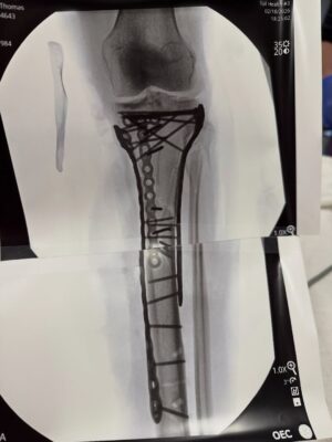 Lindsey Vonn Instagram - Made it through surgery… it took a bit more than 6 hours to complete. As you can see, it required a lot of plates and screws to put back together but Dr Hackett did an incredible job. Thank you Dr Viola for the surgery assist as well!!

With the extent of the trauma, I’ve been struggling a bit post op and have not yet been able to be discharged from the hospital just yet… almost there. Baby steps. 

Will explain the injury and what it all means soon. 

❤️🙏🏻