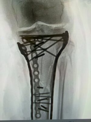 Lindsey Vonn Instagram - Made it through surgery… it took a bit more than 6 hours to complete. As you can see, it required a lot of plates and screws to put back together but Dr Hackett did an incredible job. Thank you Dr Viola for the surgery assist as well!!

With the extent of the trauma, I’ve been struggling a bit post op and have not yet been able to be discharged from the hospital just yet… almost there. Baby steps. 

Will explain the injury and what it all means soon. 

❤️🙏🏻