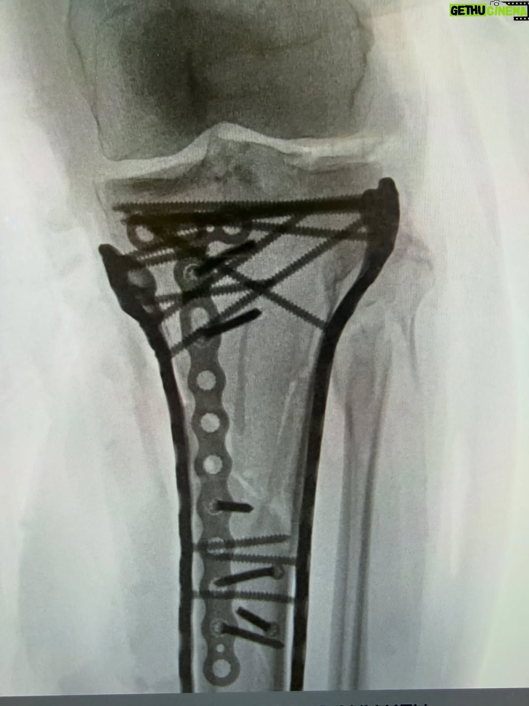 Lindsey Vonn - 441.1K Likes - Made it through surgery… it took a bit more than 6 hours to complete. As you can see, it required a lot of plates and screws to put back together but Dr Hackett did an incredible job. Thank you Dr Viola for the surgery assist as well!!

With the extent of the trauma, I’ve been struggling a bit post op and have not yet been able to be discharged from the hospital just yet… almost there. Baby steps. 

Will explain the injury and what it all means soon. 

❤️🙏🏻