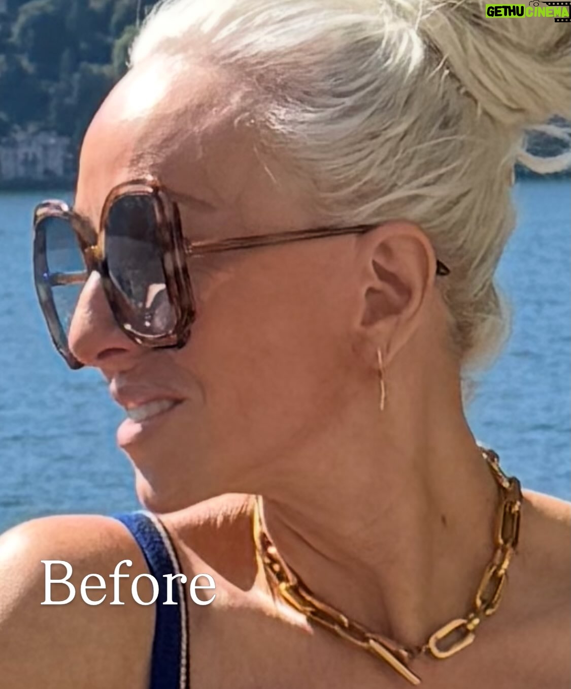 Margaret Josephs - 10K Likes - No one wants a droopy tip… some might call it a rhinoplasty I call it a “nasal rejuvenation”’😜 as I got older my tip started to droop as I smiled and I was really unhappy about it. When I was younger I never disliked my nose and could never imagine doing a nose job but with age the cartilage in my nose didn’t support my tip and it emphasized a slight bump in my nose also. Every photo of me I really noticed it and it bothered me. I went to @drgarymotykie for a slight tweak and now my nose fits my face so perfectly and no one can quite put their finger on why… not even my family members! I am a huge advocate for doing what makes YOU happy and feel your best. Thank you Dr Motykie for this subtle upgrade, it made such a huge difference to me 🙌🏼 Read the full article in @newbeauty and see photos of me scaring small children around the @bevhillshotel pool - best place to recover EVER
Thank you @tatianabido for this fab piece! 
Ps I also has fat transfer and stem cells on my face so as you swipe you’ll see the swelling, don’t freak out it 😂 it was to restore volume in the face too