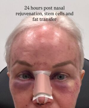Margaret Josephs Instagram - No one wants a droopy tip… some might call it a rhinoplasty I call it a “nasal rejuvenation”’😜 as I got older my tip started to droop as I smiled and I was really unhappy about it. When I was younger I never disliked my nose and could never imagine doing a nose job but with age the cartilage in my nose didn’t support my tip and it emphasized a slight bump in my nose also. Every photo of me I really noticed it and it bothered me. I went to @drgarymotykie for a slight tweak and now my nose fits my face so perfectly and no one can quite put their finger on why… not even my family members! I am a huge advocate for doing what makes YOU happy and feel your best. Thank you Dr Motykie for this subtle upgrade, it made such a huge difference to me 🙌🏼 Read the full article in @newbeauty and see photos of me scaring small children around the @bevhillshotel pool - best place to recover EVER
Thank you @tatianabido for this fab piece! 
Ps I also has fat transfer and stem cells on my face so as you swipe you’ll see the swelling, don’t freak out it 😂 it was to restore volume in the face too