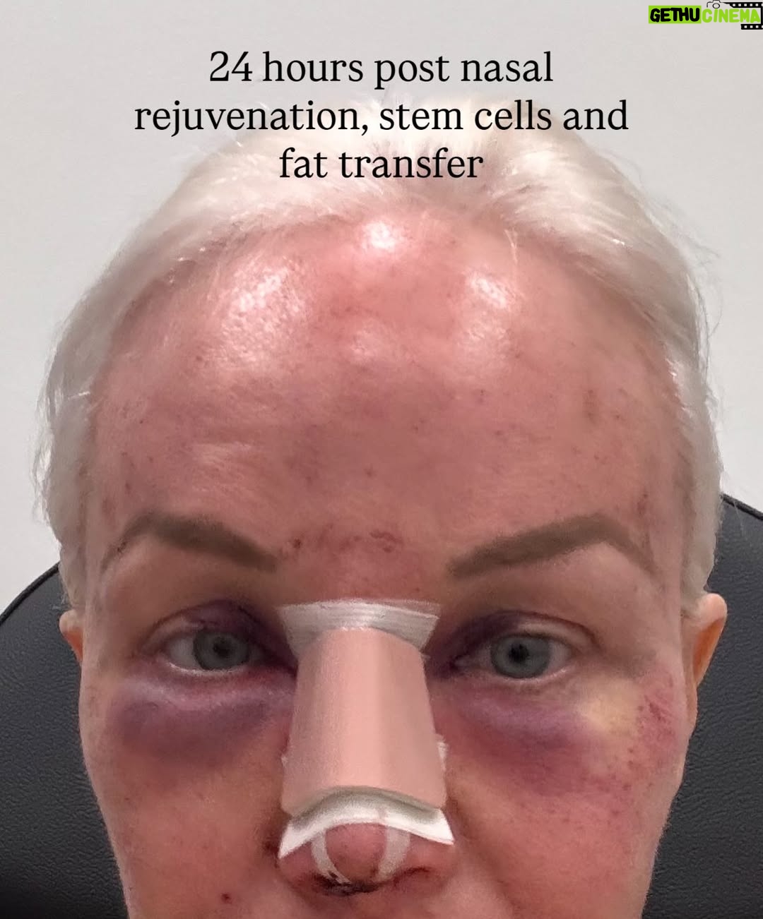 Margaret Josephs - 10K Likes - No one wants a droopy tip… some might call it a rhinoplasty I call it a “nasal rejuvenation”’😜 as I got older my tip started to droop as I smiled and I was really unhappy about it. When I was younger I never disliked my nose and could never imagine doing a nose job but with age the cartilage in my nose didn’t support my tip and it emphasized a slight bump in my nose also. Every photo of me I really noticed it and it bothered me. I went to @drgarymotykie for a slight tweak and now my nose fits my face so perfectly and no one can quite put their finger on why… not even my family members! I am a huge advocate for doing what makes YOU happy and feel your best. Thank you Dr Motykie for this subtle upgrade, it made such a huge difference to me 🙌🏼 Read the full article in @newbeauty and see photos of me scaring small children around the @bevhillshotel pool - best place to recover EVER
Thank you @tatianabido for this fab piece! 
Ps I also has fat transfer and stem cells on my face so as you swipe you’ll see the swelling, don’t freak out it 😂 it was to restore volume in the face too