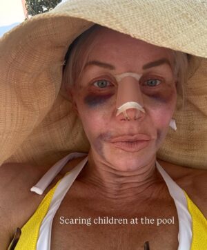 Margaret Josephs Instagram - No one wants a droopy tip… some might call it a rhinoplasty I call it a “nasal rejuvenation”’😜 as I got older my tip started to droop as I smiled and I was really unhappy about it. When I was younger I never disliked my nose and could never imagine doing a nose job but with age the cartilage in my nose didn’t support my tip and it emphasized a slight bump in my nose also. Every photo of me I really noticed it and it bothered me. I went to @drgarymotykie for a slight tweak and now my nose fits my face so perfectly and no one can quite put their finger on why… not even my family members! I am a huge advocate for doing what makes YOU happy and feel your best. Thank you Dr Motykie for this subtle upgrade, it made such a huge difference to me 🙌🏼 Read the full article in @newbeauty and see photos of me scaring small children around the @bevhillshotel pool - best place to recover EVER
Thank you @tatianabido for this fab piece! 
Ps I also has fat transfer and stem cells on my face so as you swipe you’ll see the swelling, don’t freak out it 😂 it was to restore volume in the face too