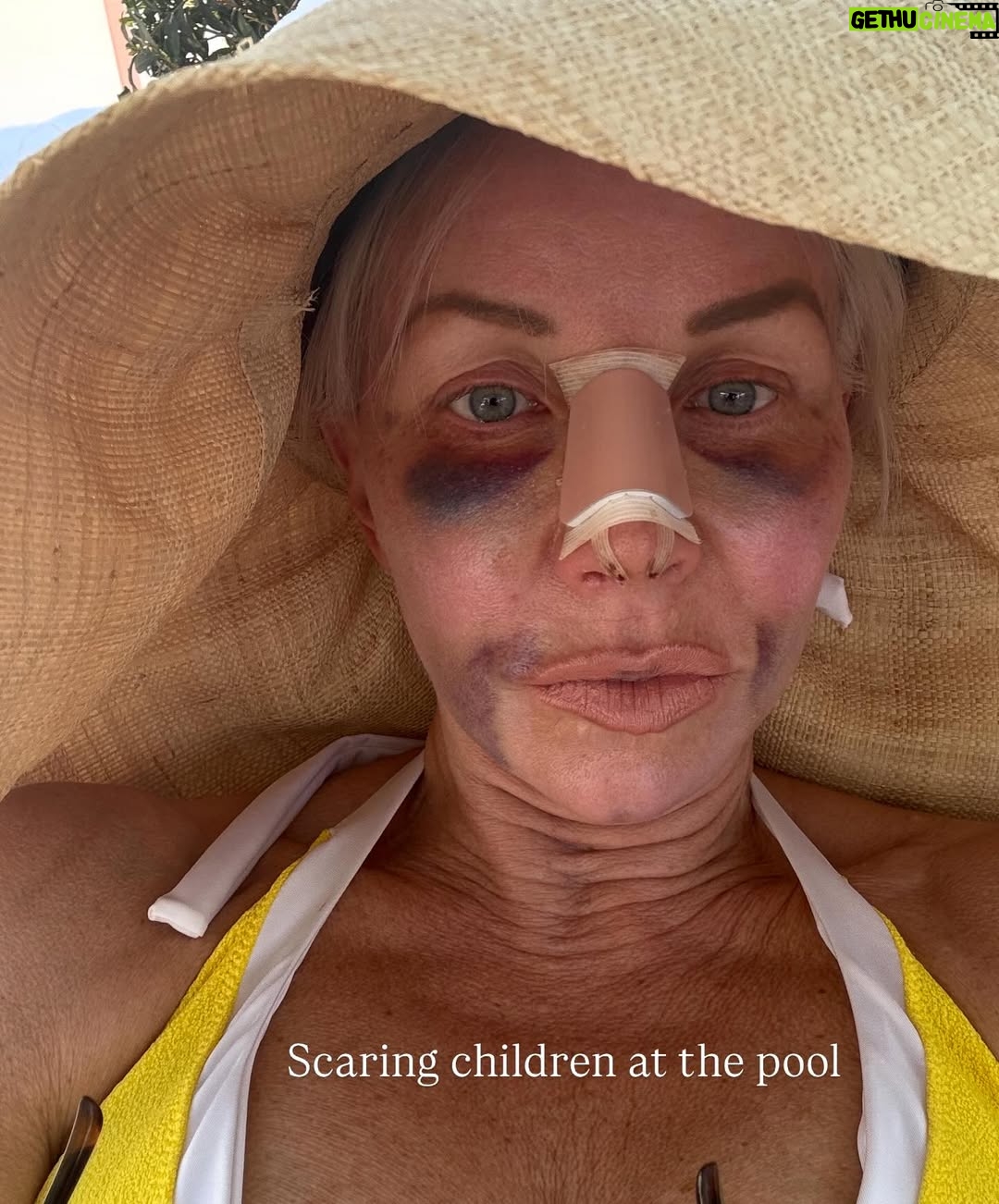 Margaret Josephs - 10K Likes - No one wants a droopy tip… some might call it a rhinoplasty I call it a “nasal rejuvenation”’😜 as I got older my tip started to droop as I smiled and I was really unhappy about it. When I was younger I never disliked my nose and could never imagine doing a nose job but with age the cartilage in my nose didn’t support my tip and it emphasized a slight bump in my nose also. Every photo of me I really noticed it and it bothered me. I went to @drgarymotykie for a slight tweak and now my nose fits my face so perfectly and no one can quite put their finger on why… not even my family members! I am a huge advocate for doing what makes YOU happy and feel your best. Thank you Dr Motykie for this subtle upgrade, it made such a huge difference to me 🙌🏼 Read the full article in @newbeauty and see photos of me scaring small children around the @bevhillshotel pool - best place to recover EVER
Thank you @tatianabido for this fab piece! 
Ps I also has fat transfer and stem cells on my face so as you swipe you’ll see the swelling, don’t freak out it 😂 it was to restore volume in the face too