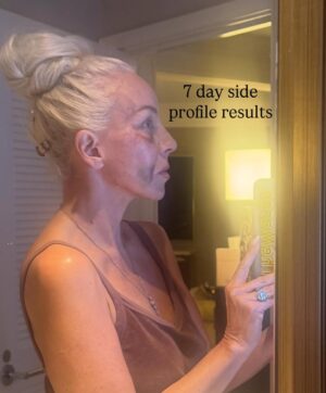 Margaret Josephs Instagram - No one wants a droopy tip… some might call it a rhinoplasty I call it a “nasal rejuvenation”’😜 as I got older my tip started to droop as I smiled and I was really unhappy about it. When I was younger I never disliked my nose and could never imagine doing a nose job but with age the cartilage in my nose didn’t support my tip and it emphasized a slight bump in my nose also. Every photo of me I really noticed it and it bothered me. I went to @drgarymotykie for a slight tweak and now my nose fits my face so perfectly and no one can quite put their finger on why… not even my family members! I am a huge advocate for doing what makes YOU happy and feel your best. Thank you Dr Motykie for this subtle upgrade, it made such a huge difference to me 🙌🏼 Read the full article in @newbeauty and see photos of me scaring small children around the @bevhillshotel pool - best place to recover EVER
Thank you @tatianabido for this fab piece! 
Ps I also has fat transfer and stem cells on my face so as you swipe you’ll see the swelling, don’t freak out it 😂 it was to restore volume in the face too