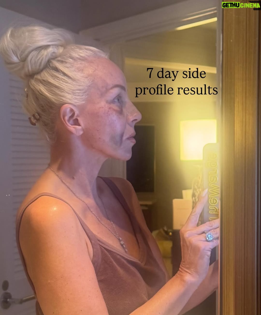Margaret Josephs - 10K Likes - No one wants a droopy tip… some might call it a rhinoplasty I call it a “nasal rejuvenation”’😜 as I got older my tip started to droop as I smiled and I was really unhappy about it. When I was younger I never disliked my nose and could never imagine doing a nose job but with age the cartilage in my nose didn’t support my tip and it emphasized a slight bump in my nose also. Every photo of me I really noticed it and it bothered me. I went to @drgarymotykie for a slight tweak and now my nose fits my face so perfectly and no one can quite put their finger on why… not even my family members! I am a huge advocate for doing what makes YOU happy and feel your best. Thank you Dr Motykie for this subtle upgrade, it made such a huge difference to me 🙌🏼 Read the full article in @newbeauty and see photos of me scaring small children around the @bevhillshotel pool - best place to recover EVER
Thank you @tatianabido for this fab piece! 
Ps I also has fat transfer and stem cells on my face so as you swipe you’ll see the swelling, don’t freak out it 😂 it was to restore volume in the face too