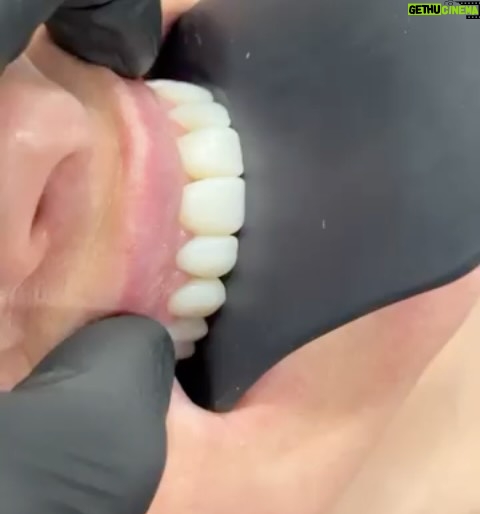 Rhian Sugden - 1.2K Likes - In January I made a big change! 🦷🪥

After years of Invisalign and my teeth gradually shifting back and forth (mainly my two front teeth), I finally admitted that the whole “wear your retainers at night for life” wasn’t for me. 

So I decided to do something more permanent and went to see @drdominicwyatt 🤩

I had composite bonding on 10 teeth. There’s no shaving them down or causing damage, it’s a really minimal, non-invasive treatment that just enhances what you already have. I wanted a natural, wider and fuller smile. 

It took over 6 hours in the chair, but it was completely worth it.

I’m so happy with the result… they’re so much better than I ever thought they would be. Here’s an appreciation post for my new smile and Dom and his dentist wizardry 👌🏼♥️

#compositebonding #compositebondinguk #teeth #newmewhodis #smile