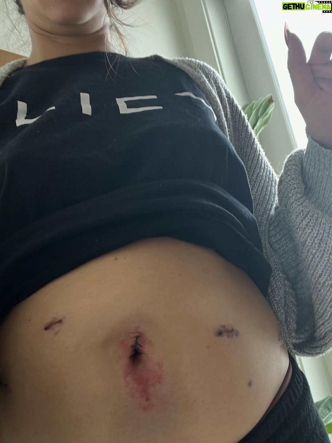 Richa Shukla Moorjani - 213.5K Likes - 2025 was many things but most of all it was the year I beat endometriosis ✌🏽 

For years, endometriosis quietly shaped my life in ways no one could see. This year, I chose to stop feeling like a prisoner in my body and to pursue excision surgery, which is currently (and absurdly) the only way to officially diagnose and treat the disease (although there is no permanent cure). I’m grateful beyond words to have had the most incredible team of healers, doctors and advocates from the holistic world to western medicine. It’s not a linear journey and it might unfortunately not even be the end of it for me, but if it offers any hope- I got pregnant 2 months after my surgery.

I’m also aware that I’m extremely privileged and lucky to have had access to the proper care and treatments that are frankly unattainable, unaffordable and completely unknown to most women dealing with this full-body illness that affects 1 in 10 of any person born with a uterus. 

If you’re living in pain and being told it’s normal- it’s NOT. I wish I could reach out and hug every one of you who shares this experience of being gaslit by the medical community and society, while dealing with debilitating pain, infertility or inexplicable other symptoms that affect pretty much every system of the body. 

A book that was written by my own surgeon’s practice founder (Dr. Iris Kerin Orbuch) “Beating Endo” was immensely helpful to me in learning how to manage endo while deciding whether or not surgery was right for me. I highly recommend starting there. 

Wishing every one of you out there a 2026 filled with joy, laughter, peace, and—most importantly, good health and the feeling of being at HOME in your body ❤️

My team of angels/healers that I owe everything to:
@beeyawellness 
@drroxannepero 
@theconsciousgut 
@iriswings 
@rayanelkattah 
And - My husband, my friends and family who held my hand through it all.